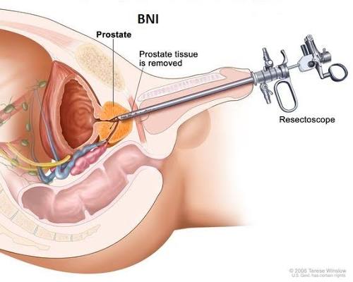 Bladder neck incision BNI